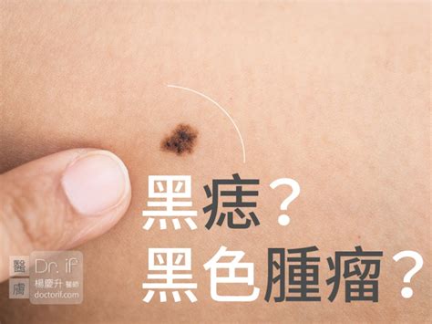 胸部有黑痣|不大驚小怪！如何辨別「黑痣」與「黑色腫瘤」？ 